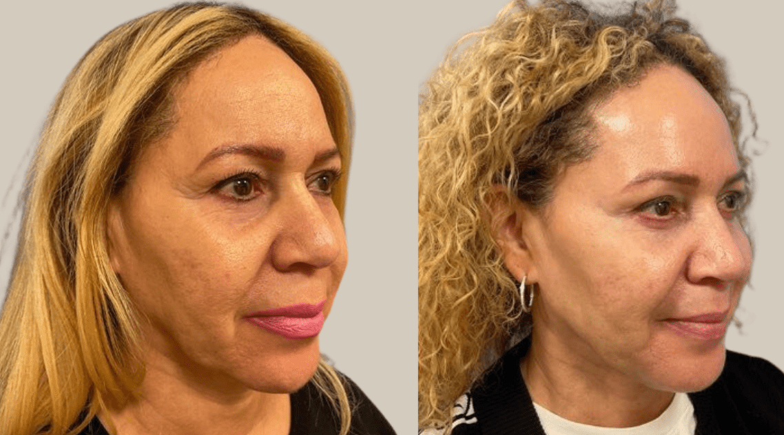 Medspa Before & After