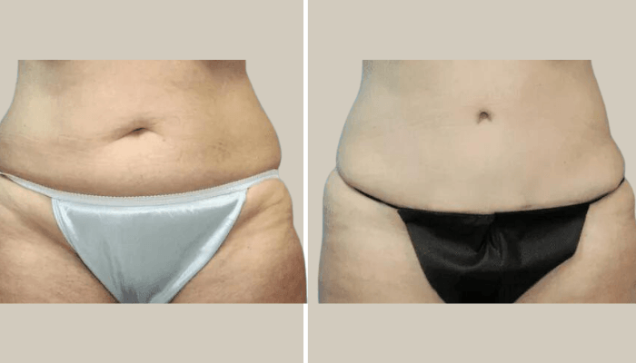 Tummy Tuck New Jersey