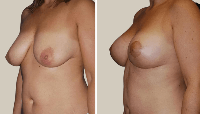 Augmentation Mastopexy and Mini-abdominoplasty-Patient 12-KTN-side