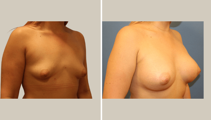 BreastAnomaly-BK Patient 13-KTN-side