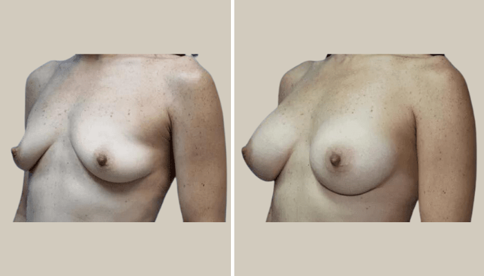 BreastAugmentation-Patient1-KTN-side