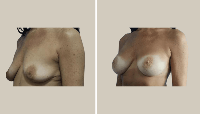 BreastAugmentation-Patient2-KTN-side