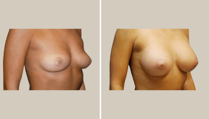 BreastAugmentation-Patient3-KTN-side