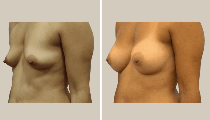 Liposuction with Breast Augmentation-Patient10-KTN-side