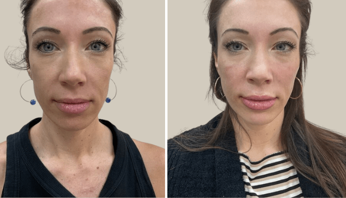 New Jersey Medspa Before & After