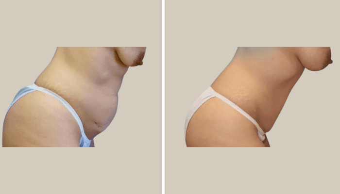 Sub-glandular breast augmentation and tummy tuck-Patient 14-KTN-side