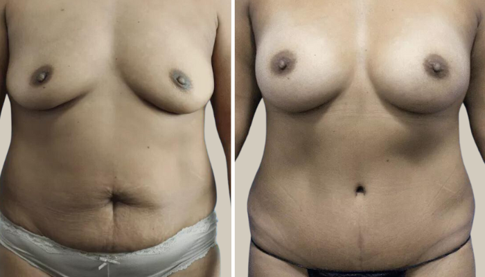 Breast Augmentation and Abdominoplasty-Patient 12-KTN-front