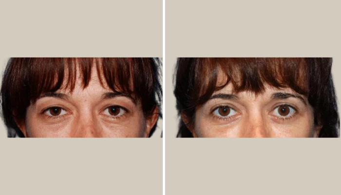 Eyelid Rejuvenation-Patient 4-KTN-front