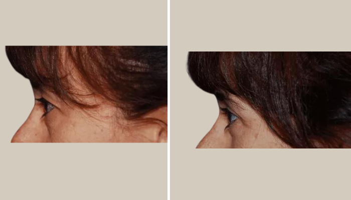 Eyelid Rejuvenation-Patient 4-KTN-side