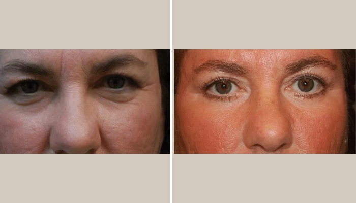 Eyelid Rejuvenation-Patient 5-KTN-side