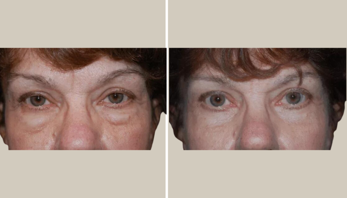 Eyelid Rejuvenation-Patient 6-KTN-front