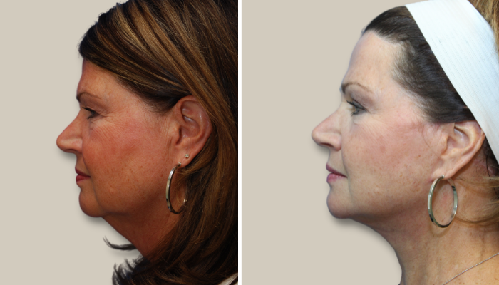 Facelift Procedure New Jersey