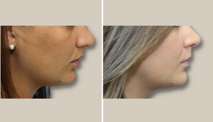 Rhinoplasty-3-KTN-side