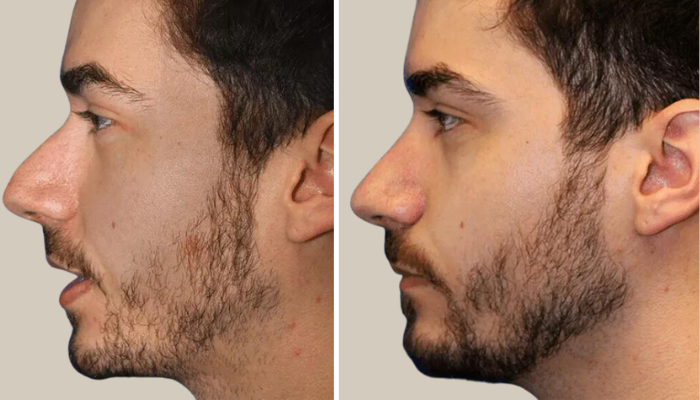 Rhinoplasty-Patient 10-KTN-side