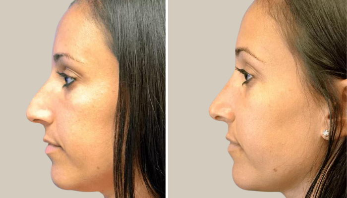 Rhinoplasty-Patient 8-KTN-side