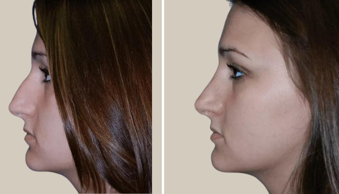 Rhinoplasty-Patient 9-KTN-side