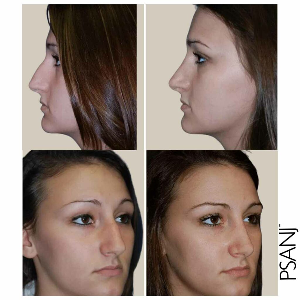 PSANJ_Nose-Surgery_Before&after-01