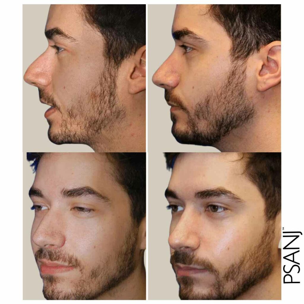 PSANJ_Nose-Surgery_Before&after-02