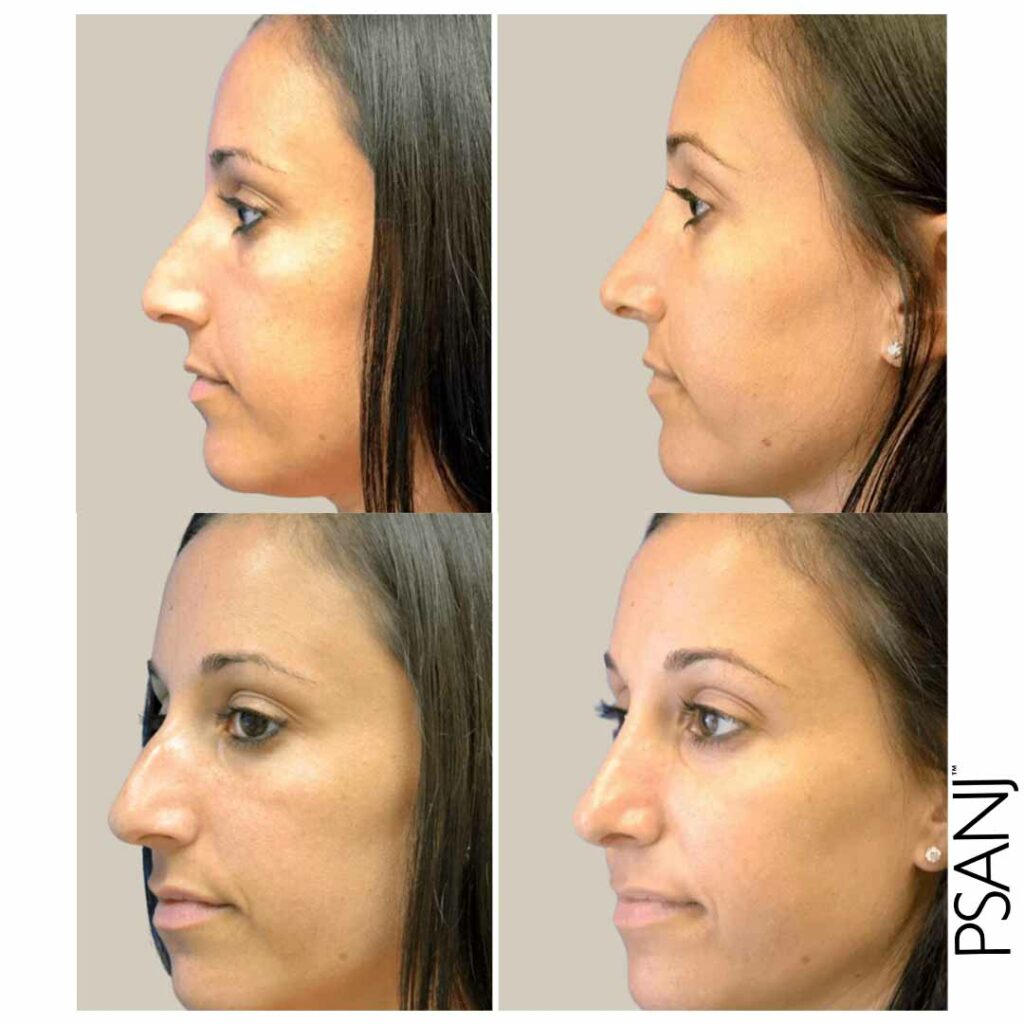 PSANJ_Nose-Surgery_Before&after-03