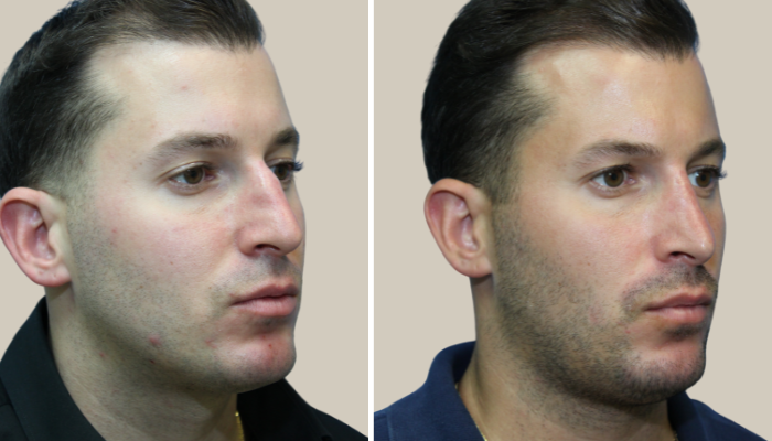 Rhinoplasty-2-KTN-3_4