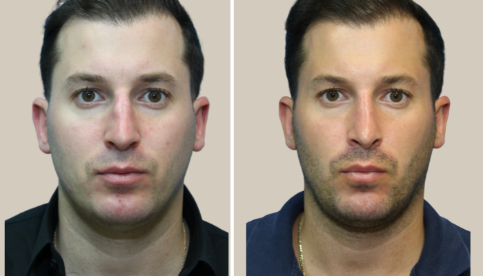 Rhinoplasty-2-KTN-front