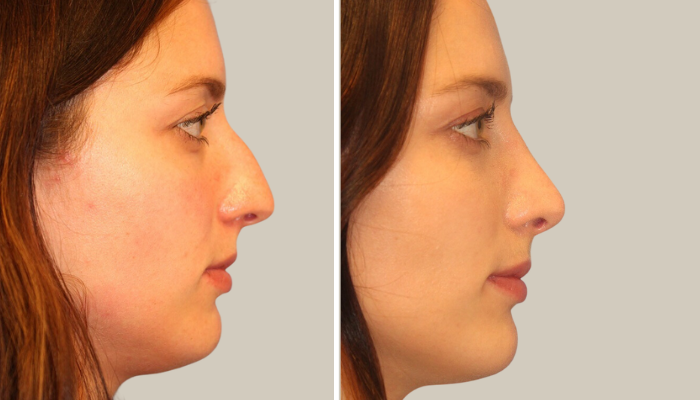 Rhinoplasty-MF-KTN-side