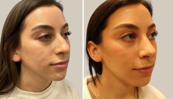 Rhinoplasty-PR-KTN-3_4