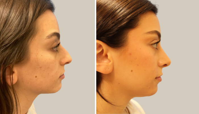 Rhinoplasty-PR-KTN-side