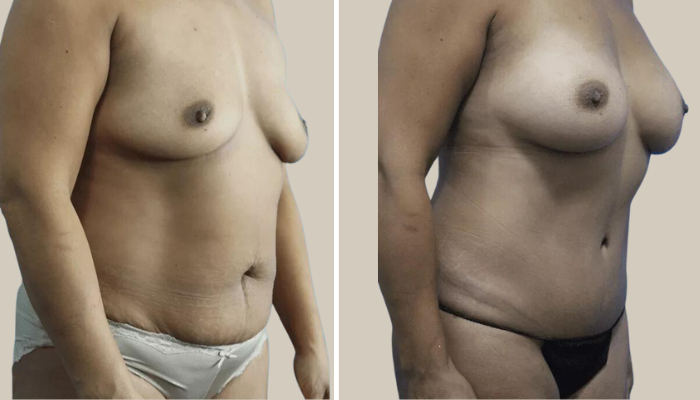 Breast Augmentation and Abdominoplasty-Patient 12-side-DN