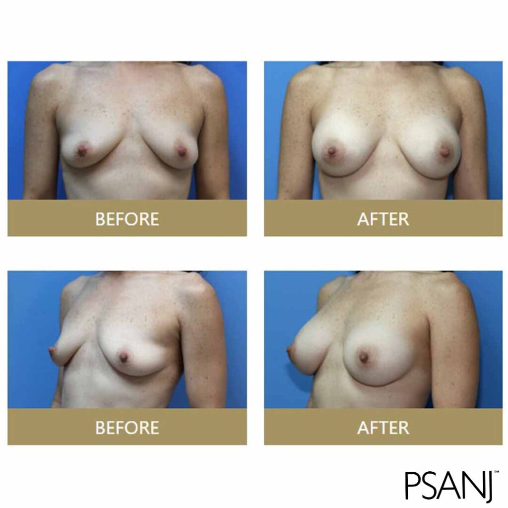 before& after_breast augmentation-01