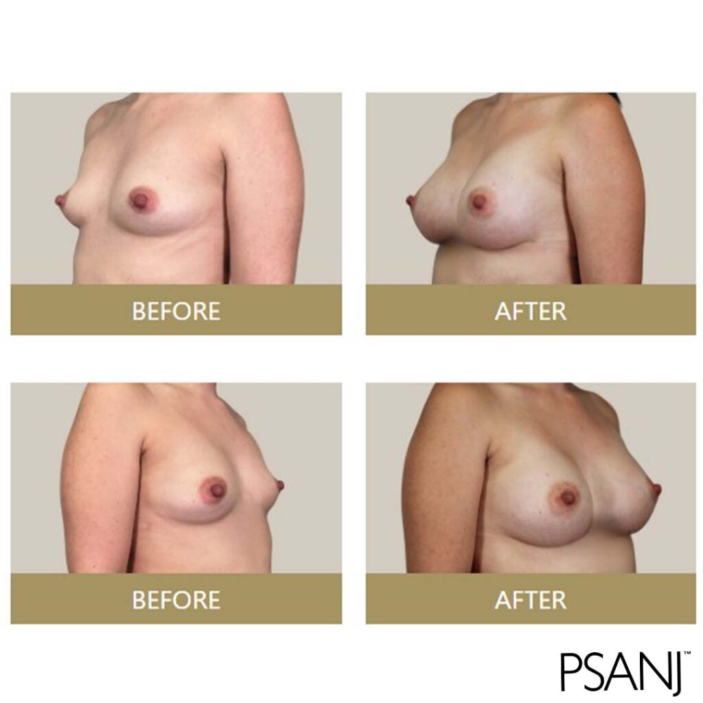 before& after_breast augmentation-02