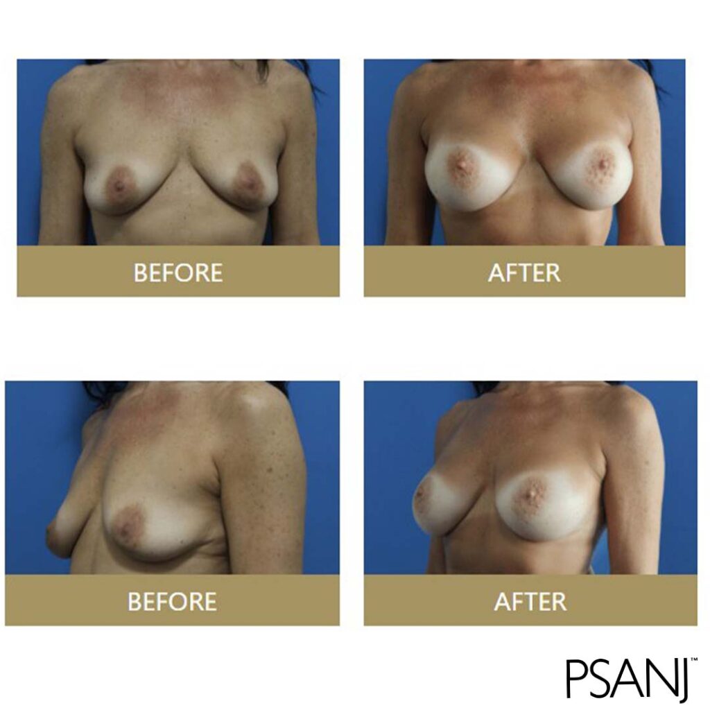 before& after_breast augmentation-03