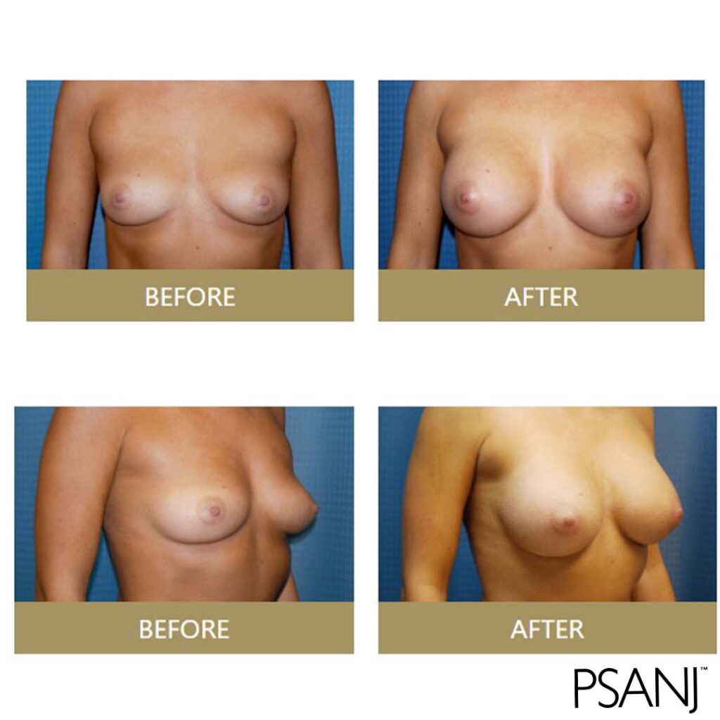 before& after_breast augmentation-04