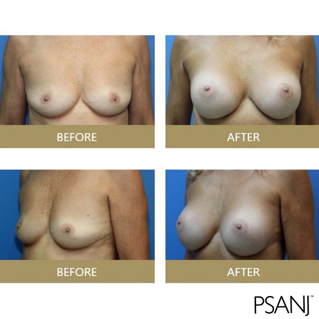 before& after_breast augmentation-05