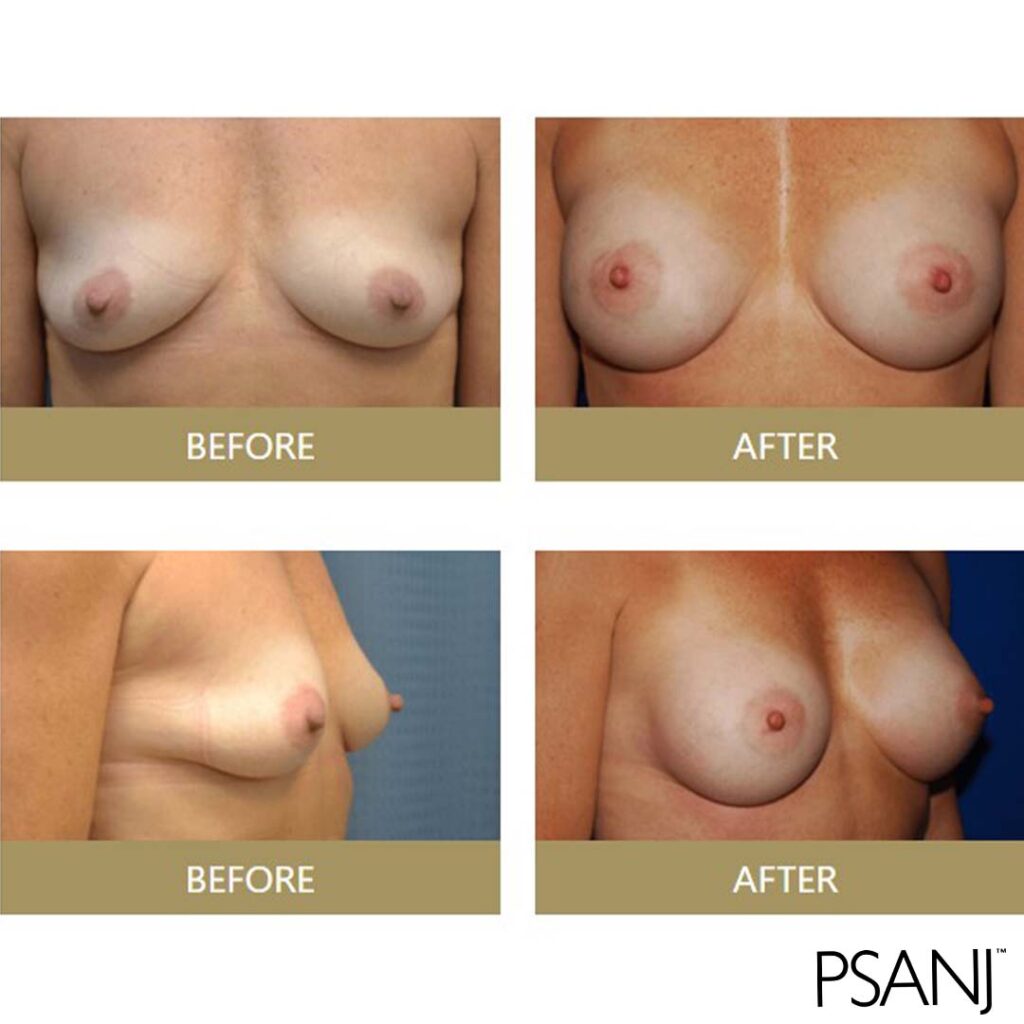 before& after_breast augmentation-06