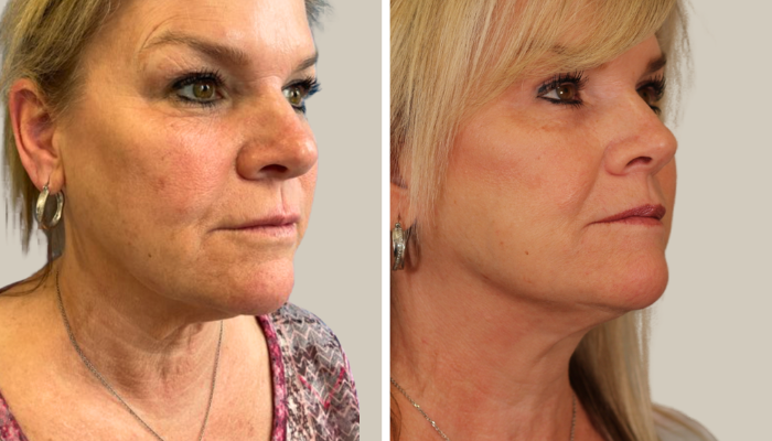 PO_KTN_Lower face lift & neck lift, Bilateral Upper Bleph (1)