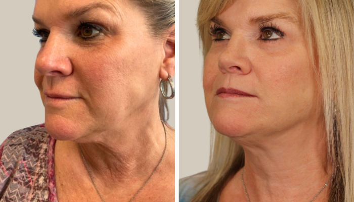 PO_KTN_Lower face lift & neck lift, Bilateral Upper Bleph (2)