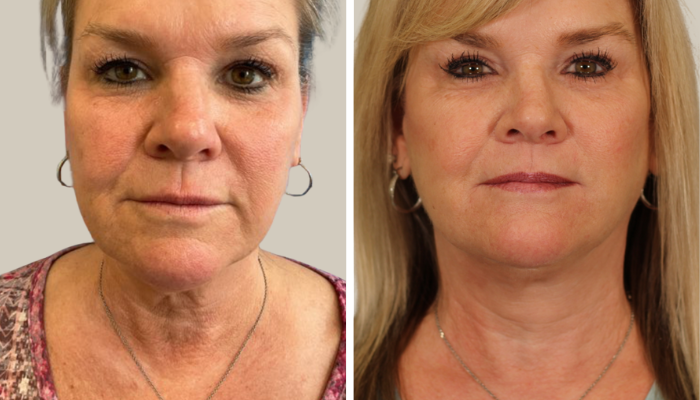 PO_KTN_Lower face lift & neck lift, Bilateral Upper Bleph